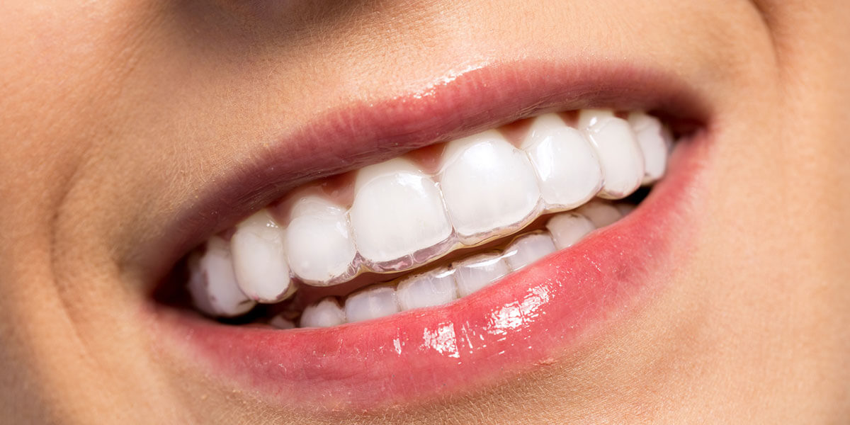 Clear aligners